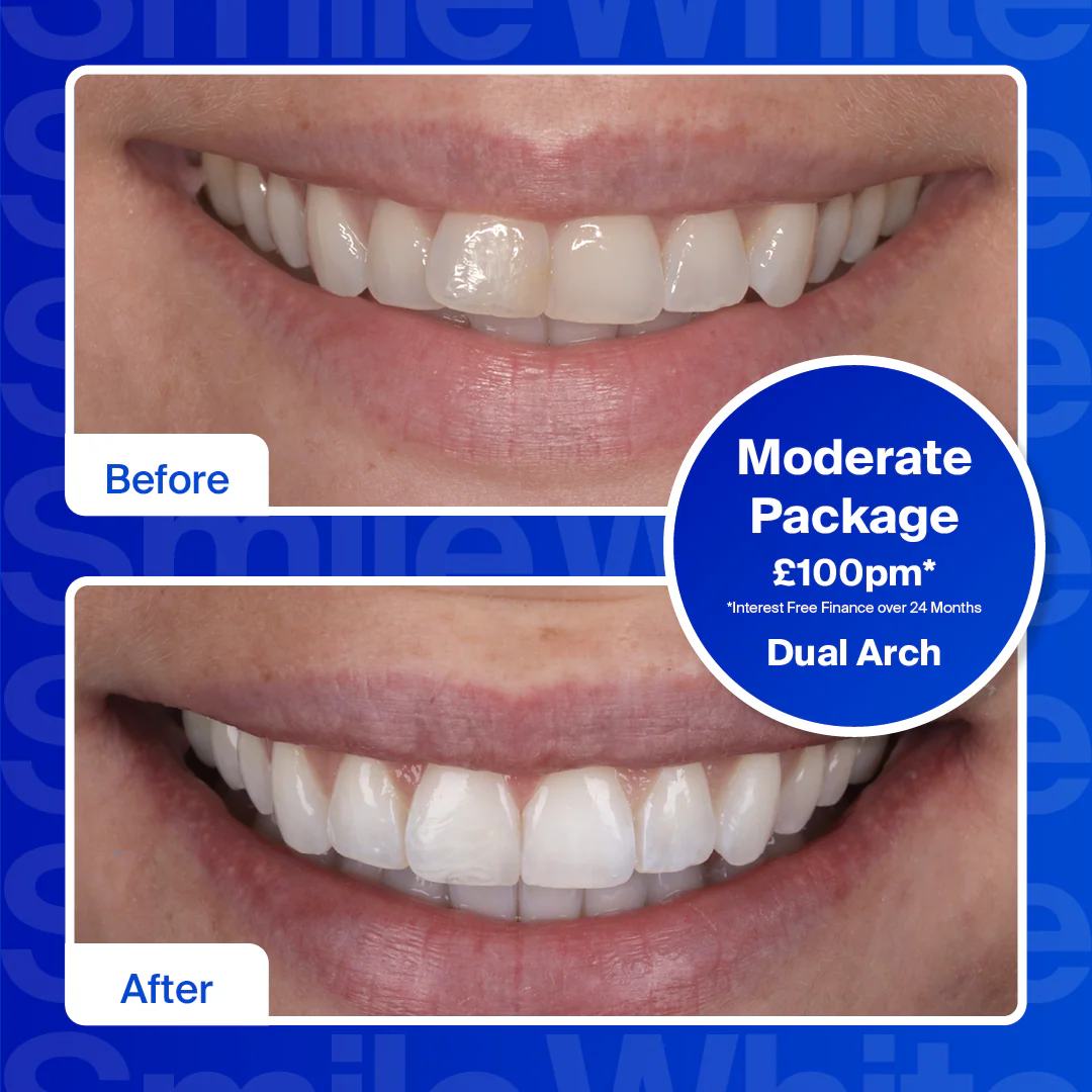 Clear Aligners - Dual Arch (top and bottom teeth)/Severe - Image 4