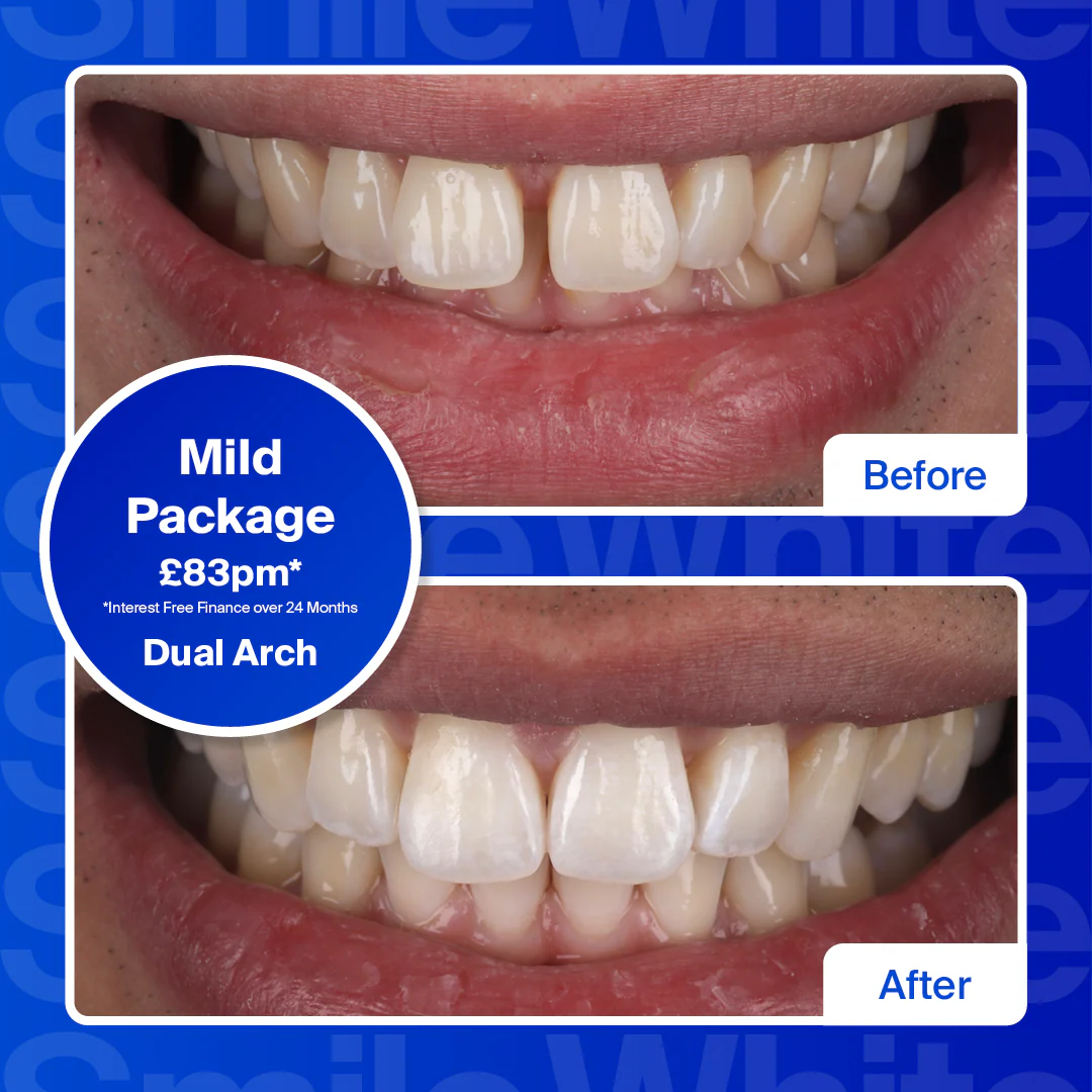Clear Aligners - Single Arch (top or bottom teeth)/Mild - Image 2