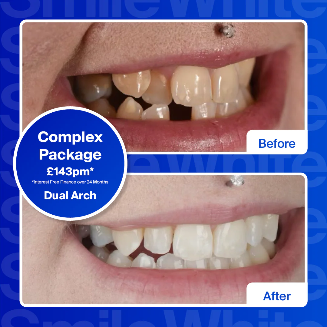 Clear Aligners - Single Arch (top or bottom teeth)/Mild - Image 5
