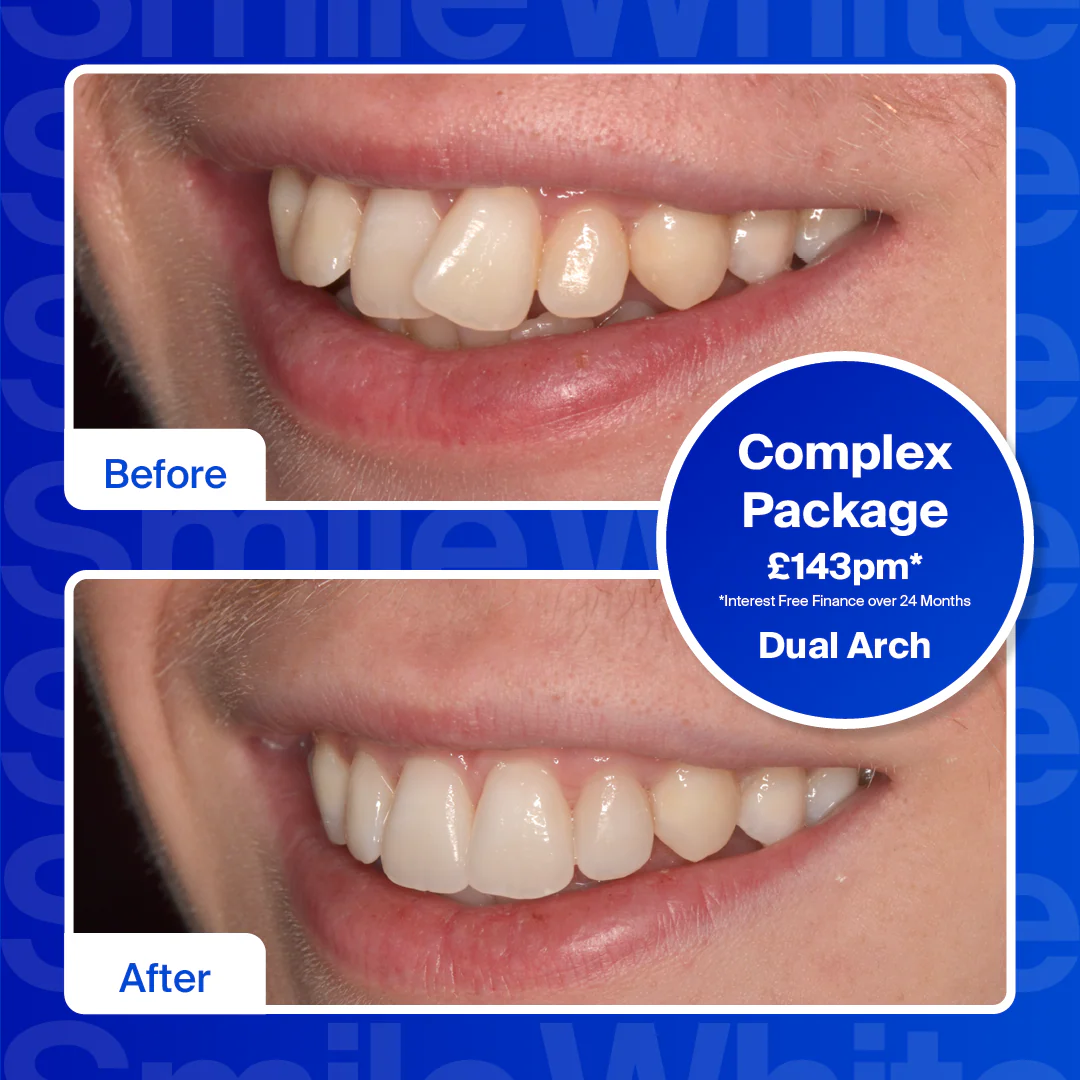 Complete Clear Aligner Treatment + Whitening - Image 3
