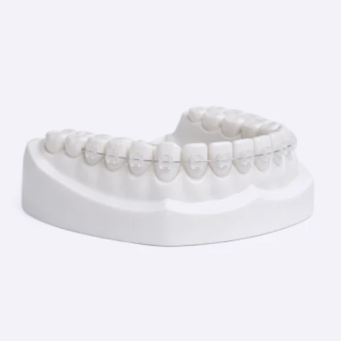 Moderate Ceramic Braces - Image 2
